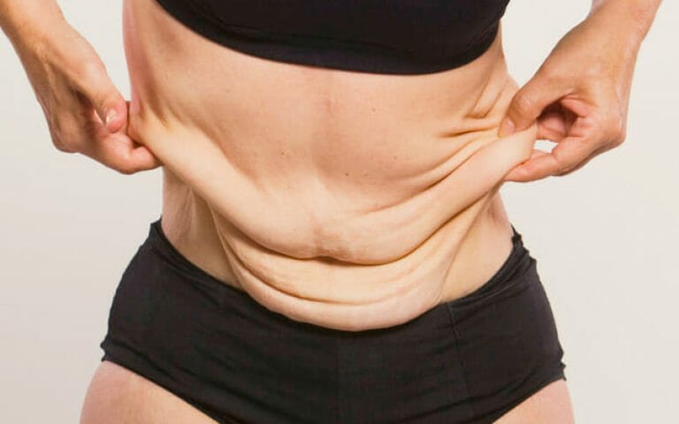 abdominoplastia